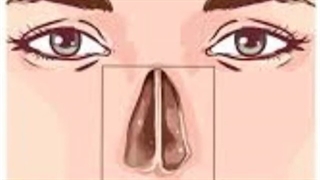 همه چیز درباره انحراف تیغه بینی