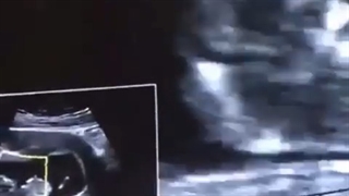 سونوگرافى باردارى جنین ١١ هفته و ٤ روز - ان تى - و تعیین جنسیت