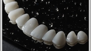 ونیرهای سرامیکی با کمترین تغییر در دندانهای شما | دکتر لیلا عطایی