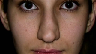 جراحی بینی طبیعی