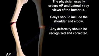 علت جوش نخوردن استخوان بازو