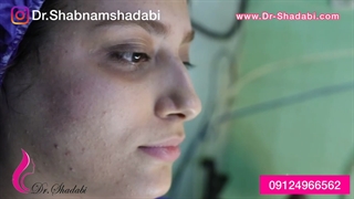 بلافاصله پس از جراحی بینی غضروفی_استخوانی
