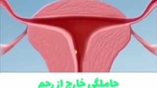 حاملگی خارج از رحم