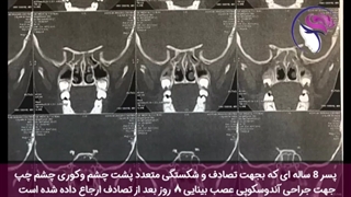فیلم واقعی جراحی آندوسکوپیک عصب بینایی