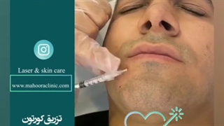 فیلم درمان قطعی ریزش سکه ای ریش