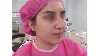 فیلم واقعی جراحی انحراف بینی